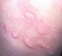 Image result for Food Allergy Hives