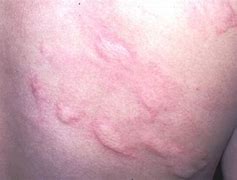 Image result for Rash in Joints From Food Allergy