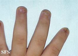 Image result for Molluscum Contagiosum Symptoms in Women