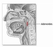 adenoideo 的图像结果