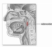 Image result for adenoidew