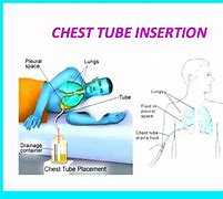 Image result for Chest Tube Positioning