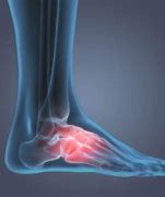 Image result for Foot Arch Pain