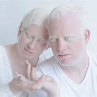 Image result for albinosmo