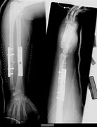 Image result for X-ray of Broken Arm