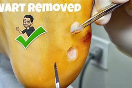 Image result for Plantar Wart Root Removal