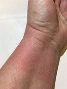 Image result for Skin Bumps On Hands