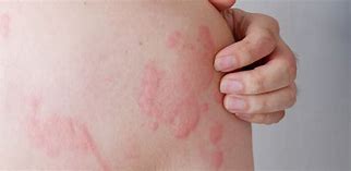 Image result for Allergic Reaction Hives On Skin Pics