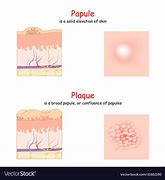 Image result for Plaque Skin Lesion