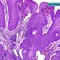 Image result for Papilloma at Back of Throat