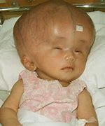 Image result for Child with Hydrocephalus