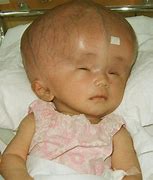 Image result for Hydrocephalus Child