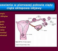 Image result for ciąża_ektopowa