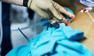 Image result for Chest Tube Removal