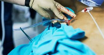 Image result for Chest Tube Placement