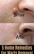 Image result for Lip Wart Removal