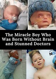 Image result for Born without a Brain Anencephaly