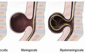 Image result for Myelocele vs Meningocele