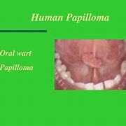 Image result for Papilloma in Mouth