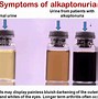 Image result for alcap5onuria