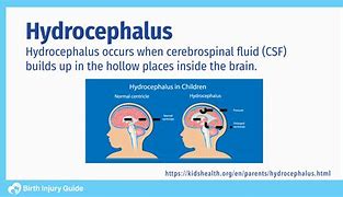 Image result for Hydrocephalus Brain Injury
