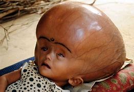 Image result for Hydrocephalus