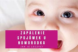 Image result for co_to_znaczy_Żółtaczka_noworodków