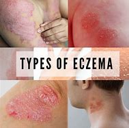 Image result for eczema