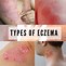 Image result for eczema