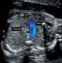 Image result for Aortic Arch On Fetal Ultrasound