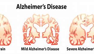 Image result for Dementia Brain Shrinkage