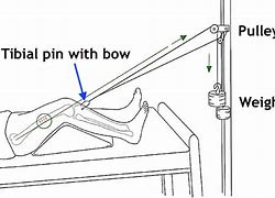 Image result for Femoral Fixation Device