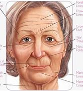 Image result for Types of Face Wrinkles