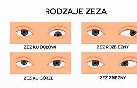 Image result for co_to_znaczy_zez_rozbieżny