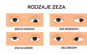 Image result for co_oznacza_zez_rozbieżny