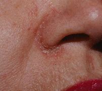 Image result for Perioral Dermatitis around Nose