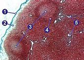 Image result for 2 Cm Lymph Node