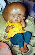 Image result for Untreated Hydrocephalus