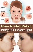 Image result for How to Get Rid of Bumps On Face