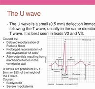 Image result for EKG U Wave Causes