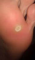 Image result for Plantar Wart Hole