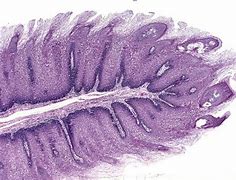 Image result for Verrucous Papilloma