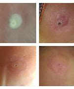 Image result for Wart Salicylic Acid On Blood