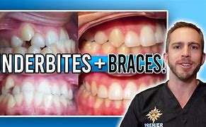 Image result for UnderBite Braces Before and After