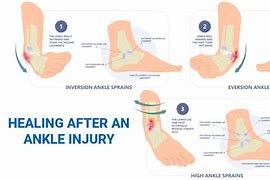 Image result for When Does a Sprain Heal