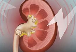 Image result for Kidney Stone Woman
