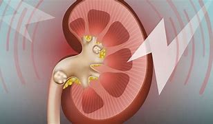 Image result for Kidney Full of Stones