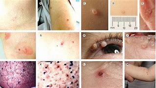 Image result for Pox Virus Molluscum