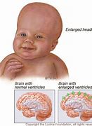 Image result for Untreated Hydrocephalus