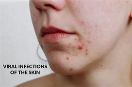 Image result for Viral Infection On Face